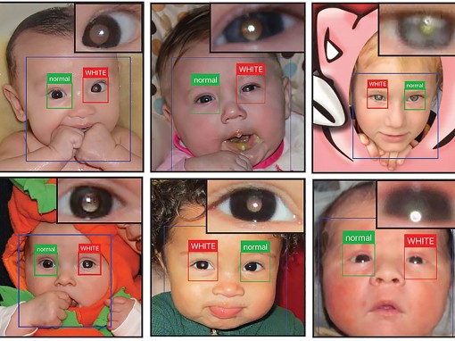 CRADLE phát hiện sớm bệnh mắt nghiêm trọng ở trẻ em