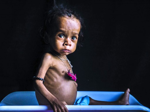 1/3 trẻ dưới 5 tuổi bị suy dinh dưỡng hoặc thừa cân