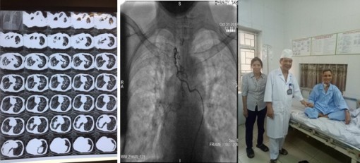 Cứu sống bệnh nhân "ho ra máu sét đánh"