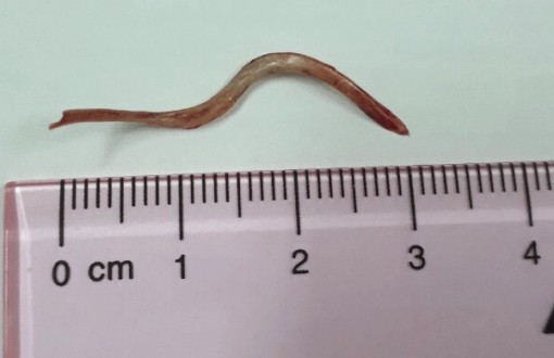 Cứu sống cụ bà nuốt phải xương cá làm mủ trong ổ bụng