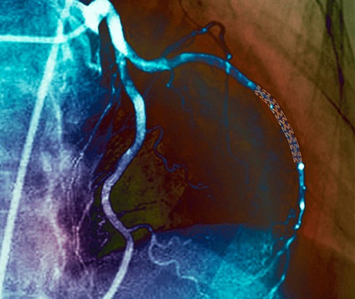 Thuốc điều trị hẹp mạch máu hiệu quả như phẫu thuật xâm lấn