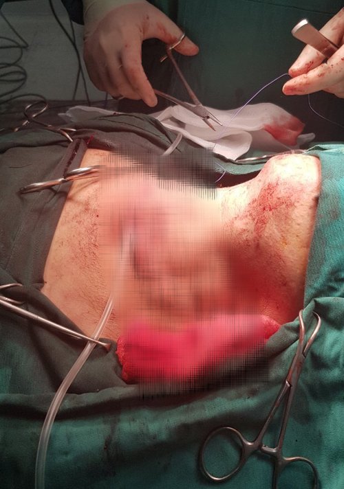 Phẫu thuật khối bướu cổ “khủng” đeo đẳng bệnh nhân gần 30 năm