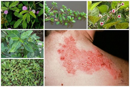 Lá cây chữa zona thần kinh & bài thuốc đặc trị Ngưu Bì Giải Độc Ẩm