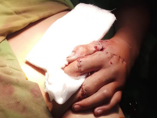 Điều trị thành công trường hợp bàn tay

dập nát do dùng pháo tự chế