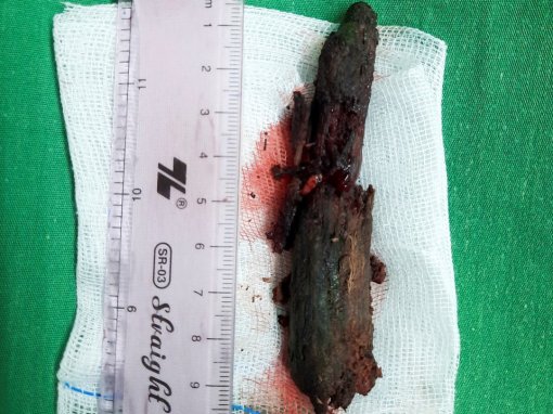 Bé trai 8 tuổi bị khúc gỗ xuyên thấu mũi