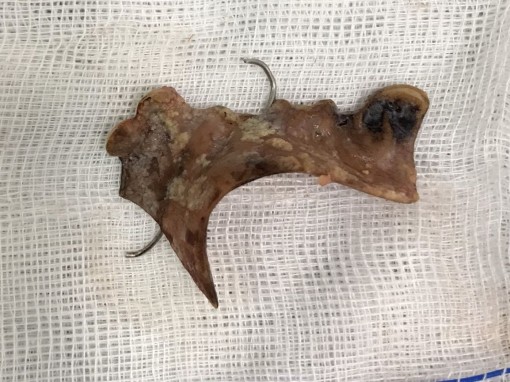 Lấy hàm răng giả từ họng thanh quản bệnh nhân nam