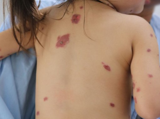 Điều trị thành công cho bé gái lở loét toàn thân nghi do thuốc