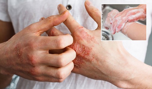 Bảo vệ da khi phải rửa tay nhiều lần trong ngày