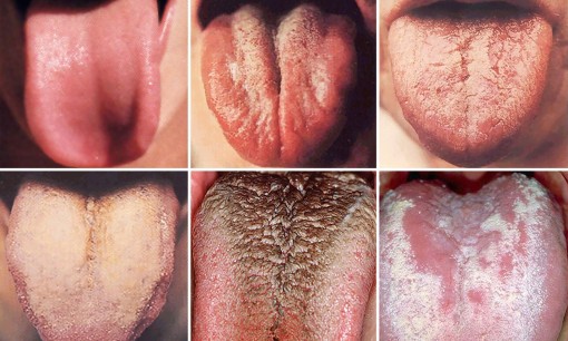 Nhìn lưỡi, chẩn bệnh cho bản thân