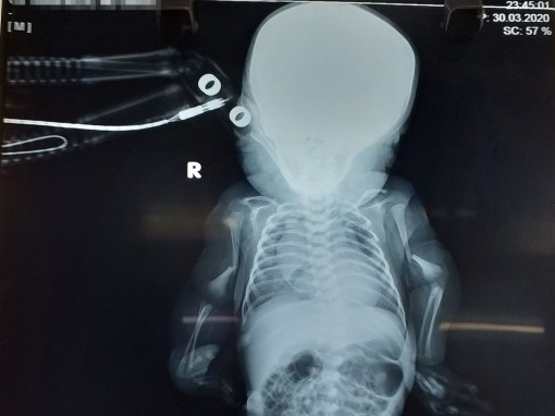 Phát hiện trẻ sơ sinh mắc bệnh xương thủy tinh rất hiếm gặp