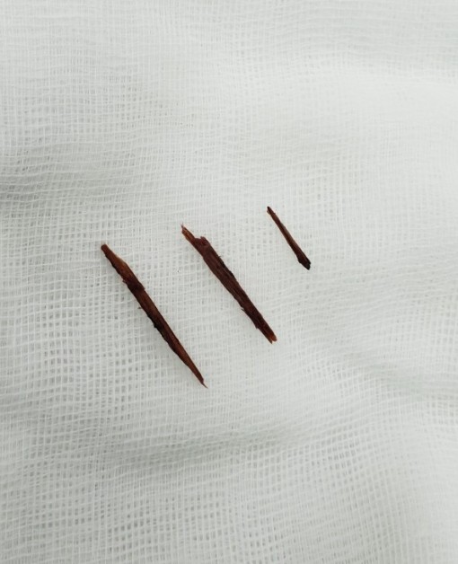 Cưa cây, dăm gỗ văng thủng bụng