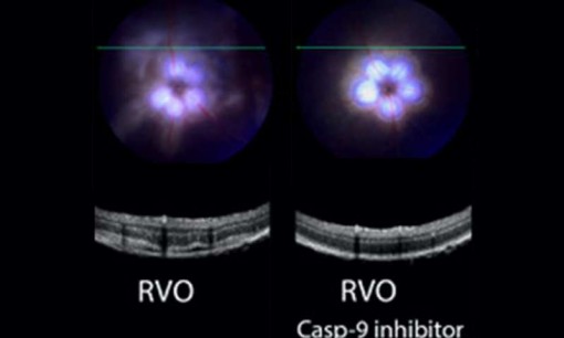 Thuốc nhỏ mắt ngăn chặn mù lòa do tắc tĩnh mạch võng mạc
