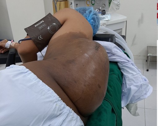 Mổ bỏ khối bướu hơn 4kg trên lưng