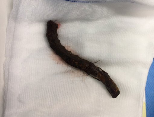 Cứu sống bệnh nhân bị thanh sắt xuyên sọ