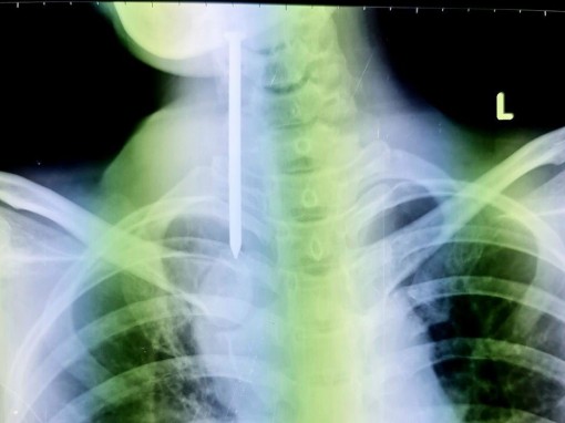 Cứu kịp thời bệnh nhân nuốt đinh