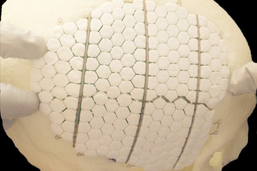 BioCer - vật liệu sinh học phát triển trong lỗ thủng hộp sọ