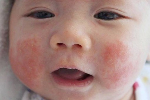 Vitamin D giúp giảm triệu chứng chàm ở trẻ em