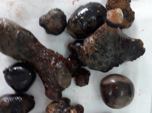 Triển khai lấy sỏi san hô

bằng kỹ thuật hạ nhiệt