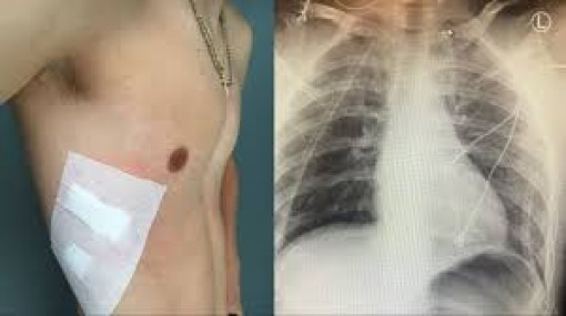 Thuốc lá điện tử làm tăng nguy cơ mắc COPD và COVID-19