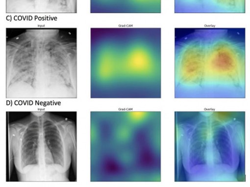 AI chẩn đoán COVID-19 trên phim X-quang đúng và nhanh gấp 10 lần chuyên gia