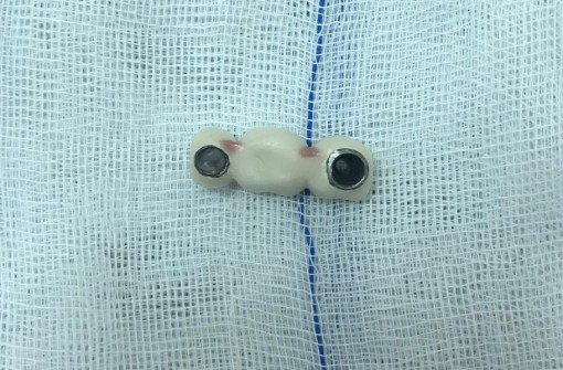 Nuốt 4 răng giả trong lúc ăn cơm