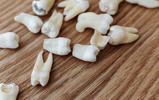 Mất răng là dấu hiệu suy giảm trí não