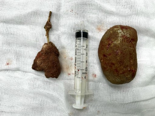 Cấp cứu vì quên ống thông trong niệu quản 5 năm