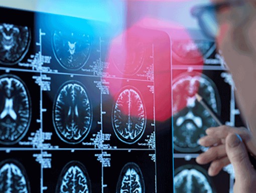 Phát hiện thêm 42 vùng gien là yếu tố nguy cơ của bệnh Alzheimer