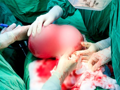 Phẫu thuật tách khối u xơ tử cung nặng 5,5kg