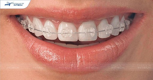 Giải đáp 6 thắc mắc thường gặp về niềng răng mắc cài sứ