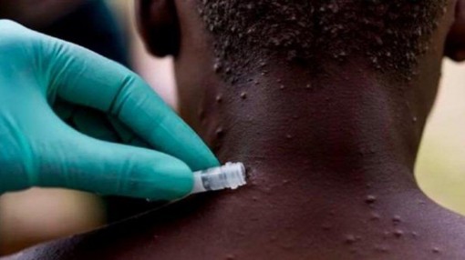 Bệnh đậu mùa khỉ đã lan ra 30 quốc gia