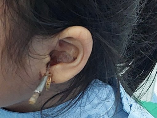 Bé gái bị thủng màng nhĩ do tự lấy ráy tai