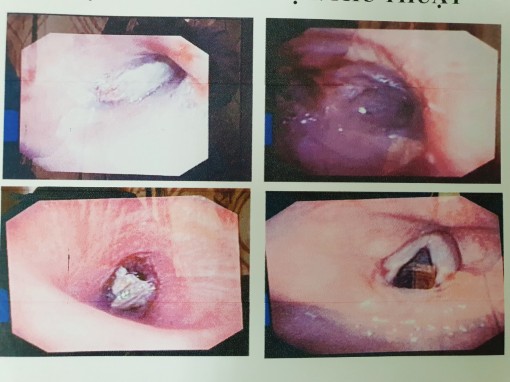 Xương heo nằm cả năm trong phế quản một người đàn ông