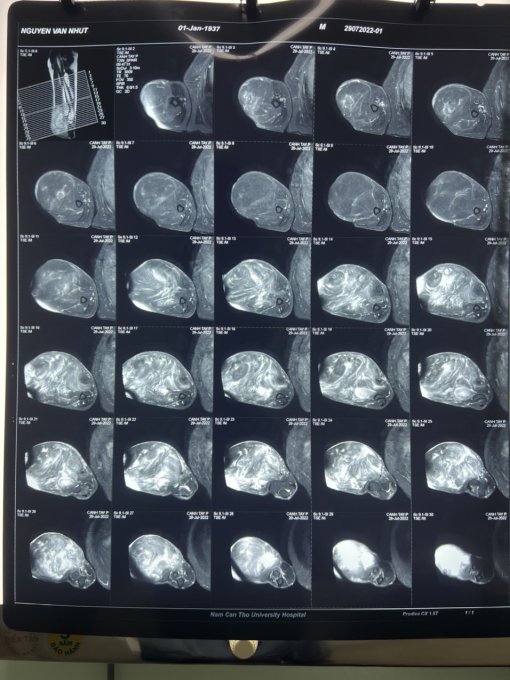 Bệnh viện Đại học Nam Cần Thơ phẫu thuật điều trị thành công bướu phần mềm cánh tay (p) rất to trên bệnh nhân cao tuổi