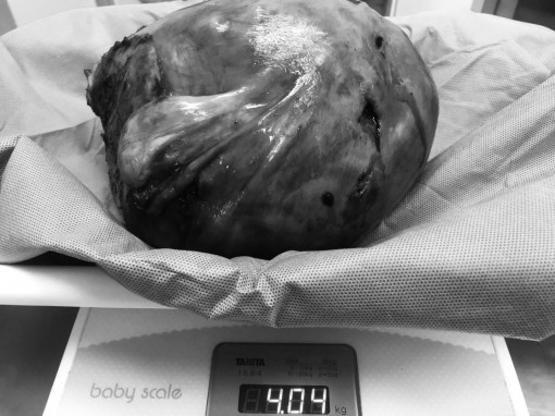 Phẫu thuật cắt khối u tử cung hơn 4kg cho sản phụ