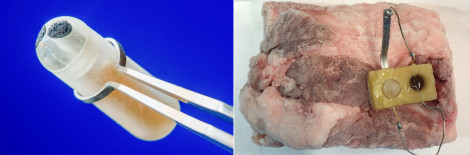Cảm biến theo dõi mức glucose trong ruột