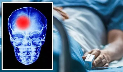 Những dấu hiệu cảnh báo sớm 1 tuần trước cơn đột quỵ