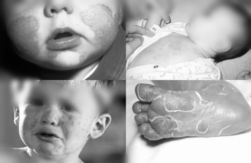 Phòng ngừa em bé sơ sinh mắc giang mai