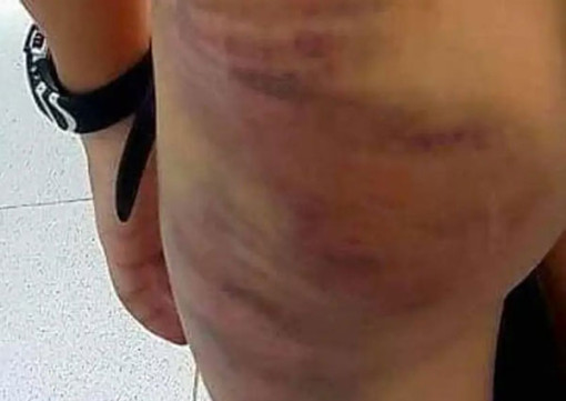 Cà Mau: Mẹ kế đánh con bầm tím khắp người