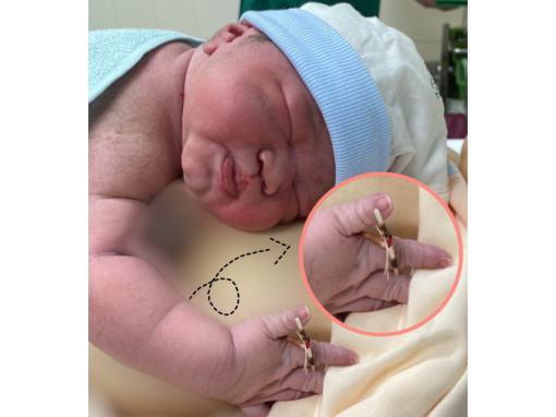 Hy hữu bé gái chào đời với vòng tránh thai của mẹ