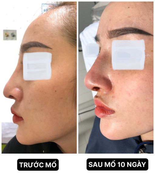 Cô gái trẻ bị viêm sưng, chảy mủ mũi do nâng mũi