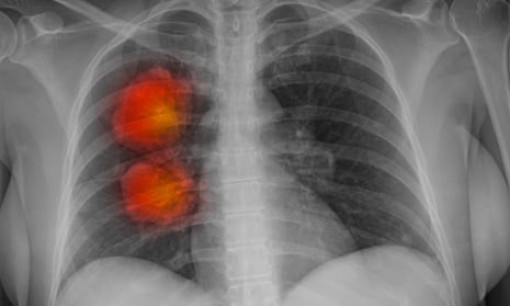 Công cụ AI mới có thể xác định chính xác bệnh ung thư