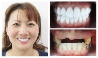Cấy implant có đau không? Gợi ý địa chỉ cấy implant uy tín nhất