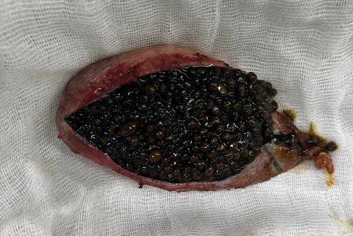 Phát hiện hơn 1.000 viên sỏi trong túi mật một bệnh nhân