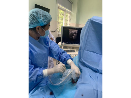 Kỹ thuật tiên tiến tạo "đường hầm" lọc máu cho bệnh nhân suy thận