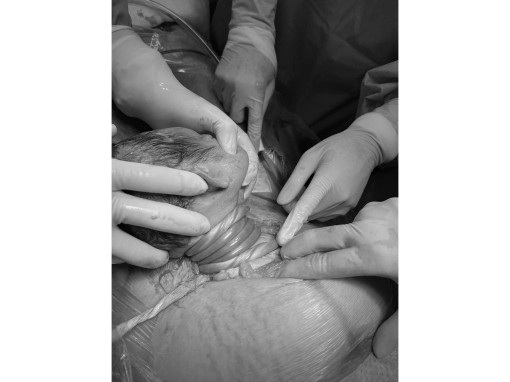 Cứu kịp thai nhi dây rốn quấn cổ 5 vòng