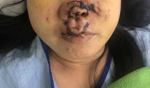 Nổ bình gas mini: Một phụ nữ bị đa chấn thương mặt, gãy răng