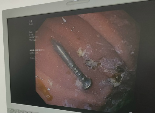 Gắp cây đinh 3 phân trong bụng bé trai