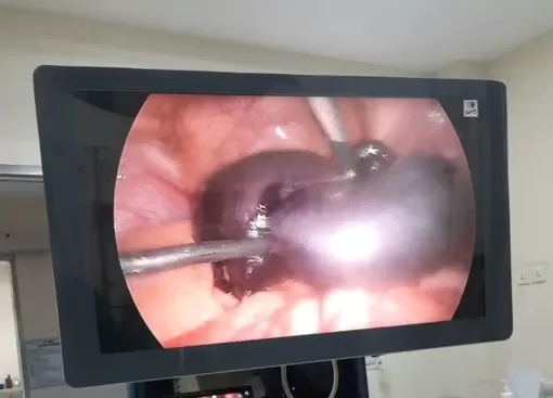 Cẩn trọng với bệnh lý buồng trứng ở bé gái