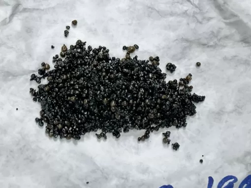 Phẫu thật nội soi cho bệnh nhân mang hơn 3.200 viên sỏi trong túi mật